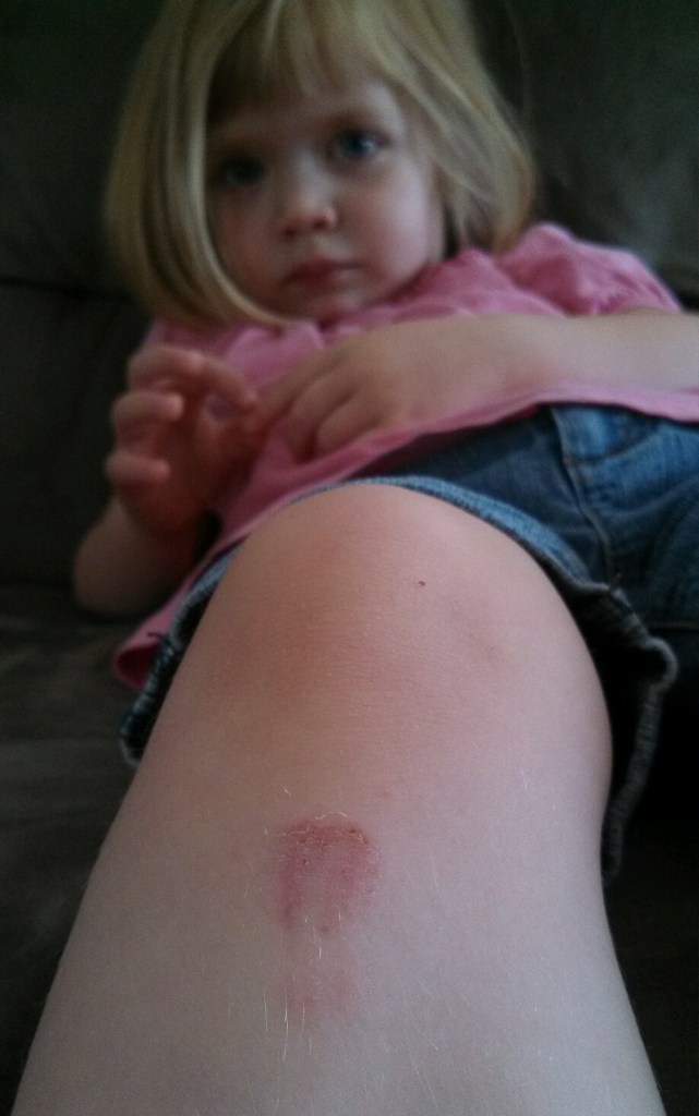 Lauren's skinned knee